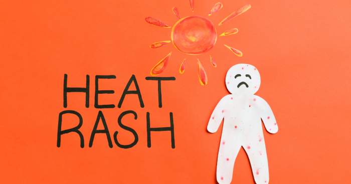 Heat Rash